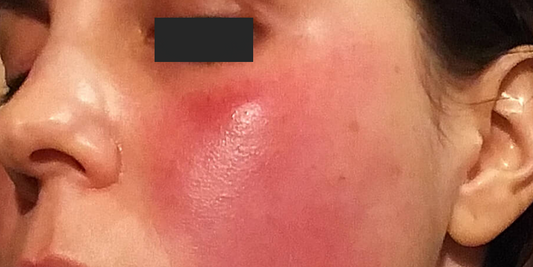 Conquering Rosacea: Navigating the Path to Clearer Skin