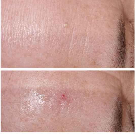 Milia Removal Results