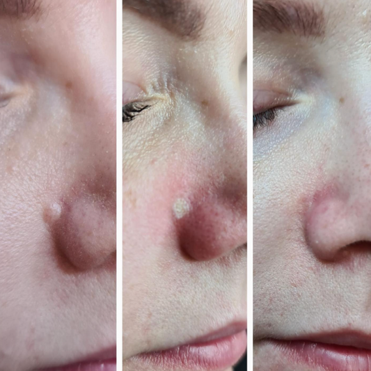 Mole Reduction Results