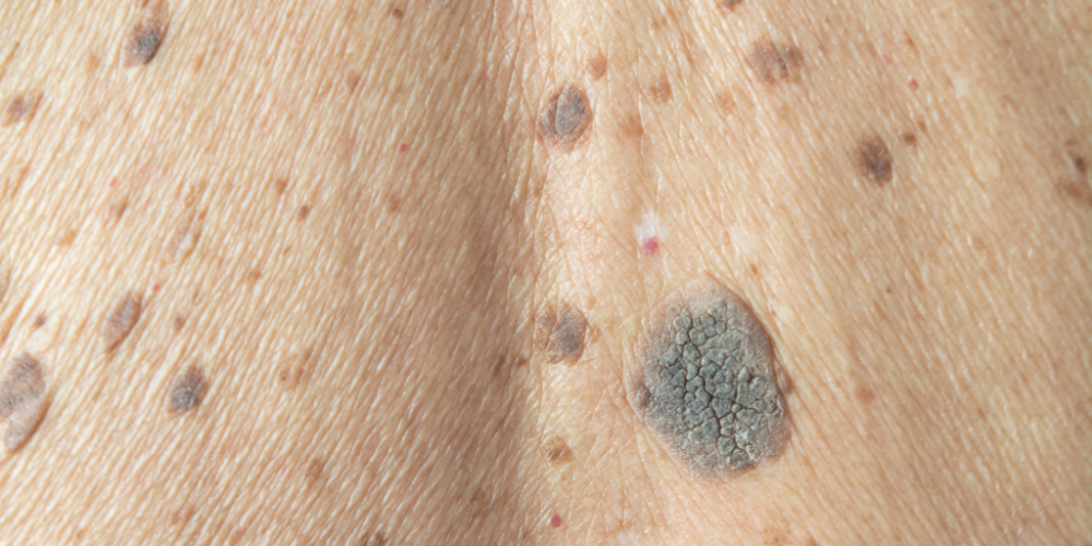 Seborrhoeic Keratosis, Pigmentation & Age spots