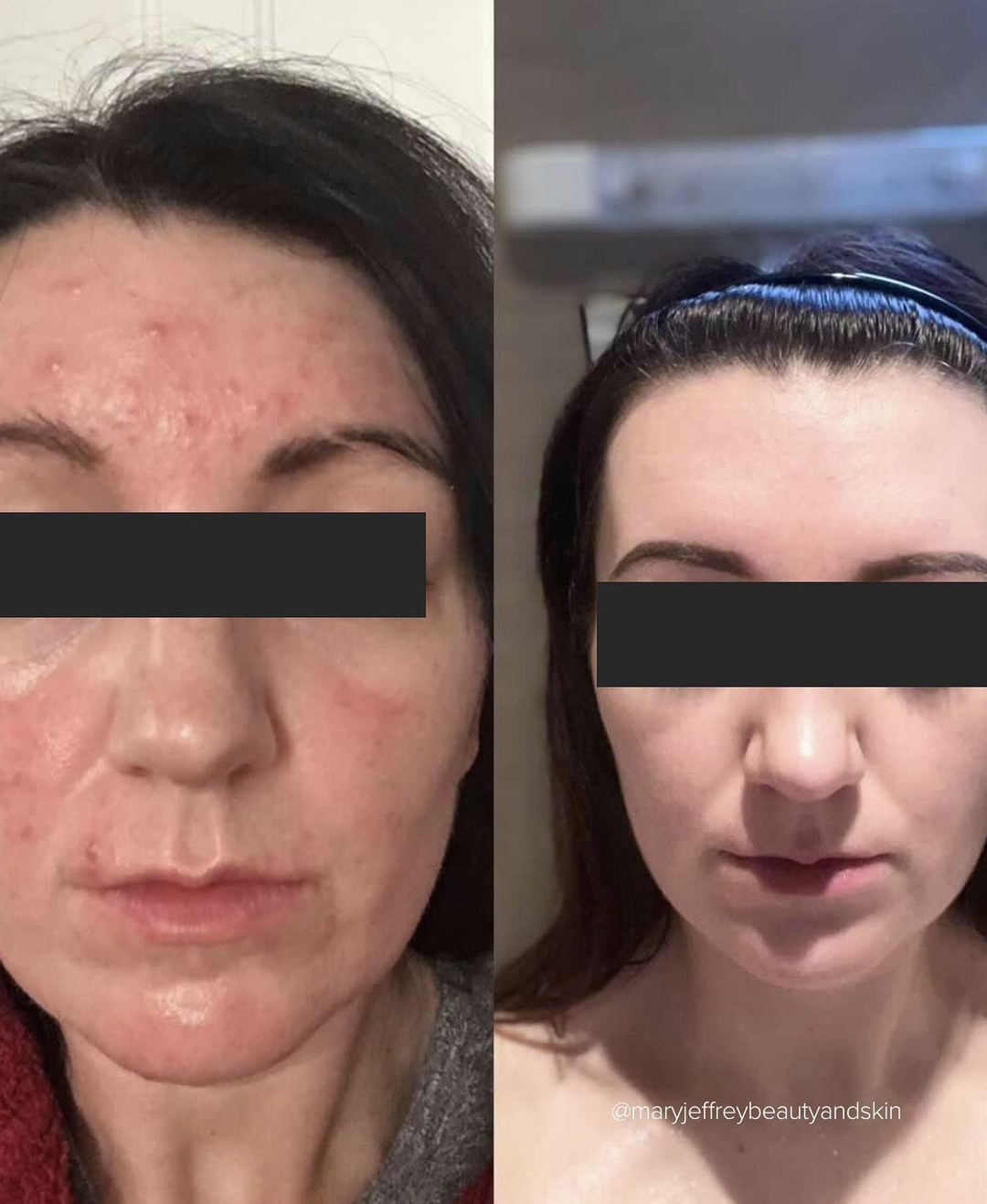 Before and after results of an acne treatment.