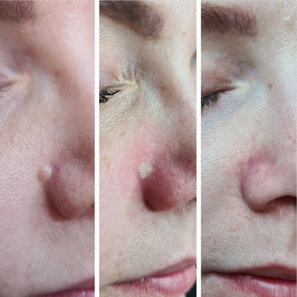 A mole reduction treatment, on a mole by the nose.