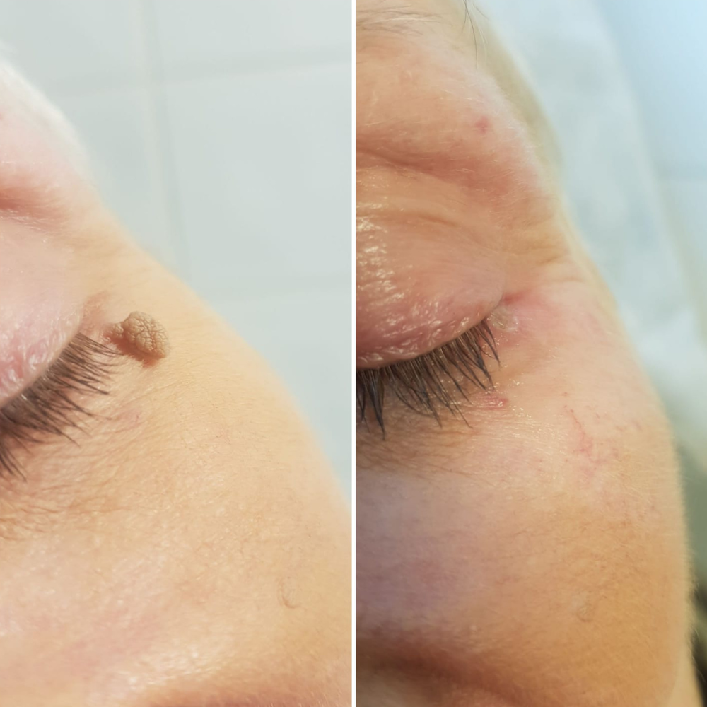 Before and after of a treatment of a skin tag underneath a client's eye.