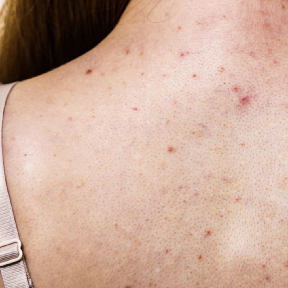 A woman's back with mild acne.