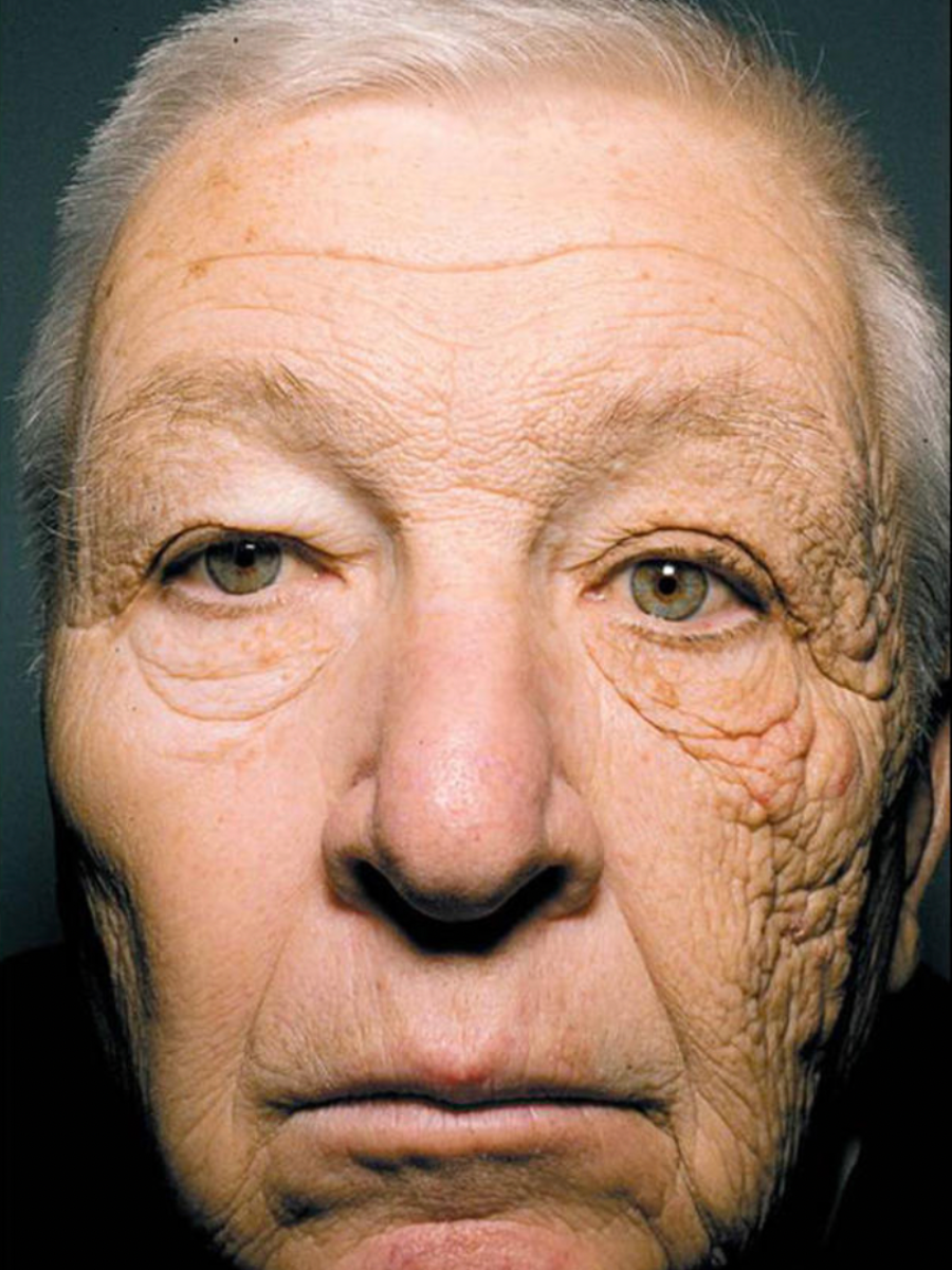 A truck driver shows the effect of UV damage on one side of his face.