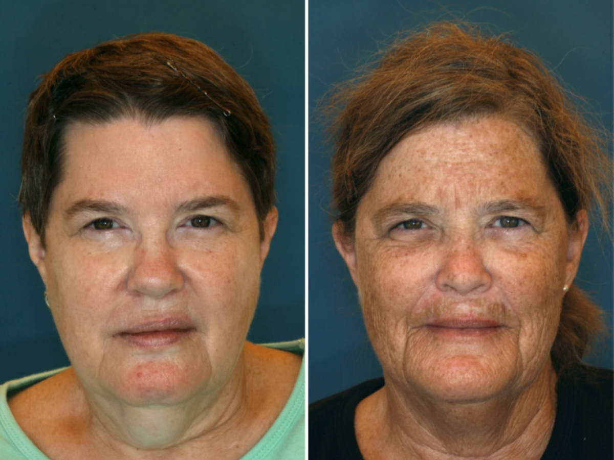 The twin study showing the effects of sun damage.